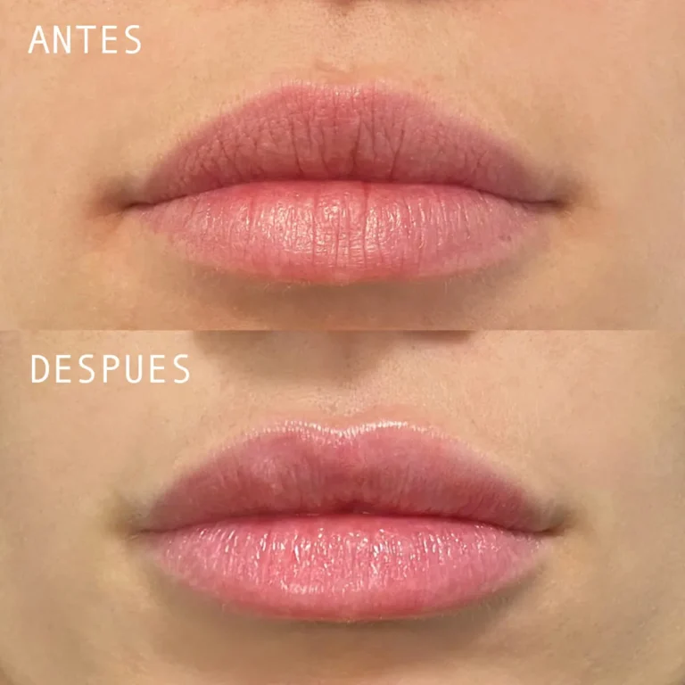 Clinica-Noelia-Gon-Medicina-Estetica-Facial-Relleno-de-Labios-2.jpg.webp