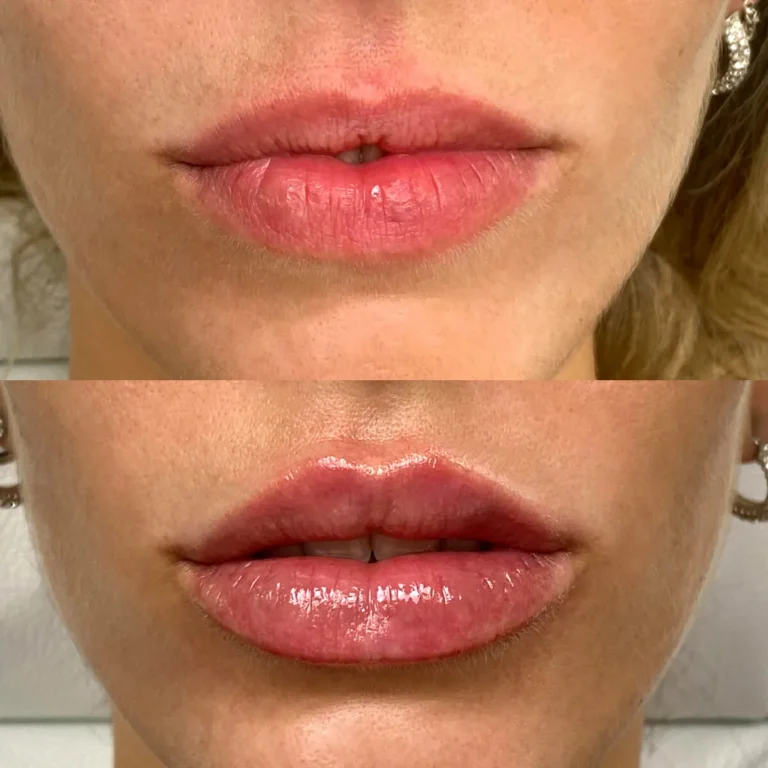 Clinica-Noelia-Gon-Medicina-Estetica-Facial-Relleno-de-Labios-3.jpg.webp