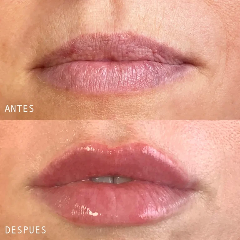 Clinica-Noelia-Gon-Medicina-Estetica-Facial-Relleno-de-Labios-4.jpg.webp