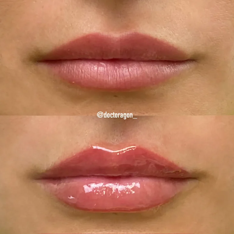 Clinica-Noelia-Gon-Medicina-Estetica-Facial-Relleno-de-Labios.jpg.webp