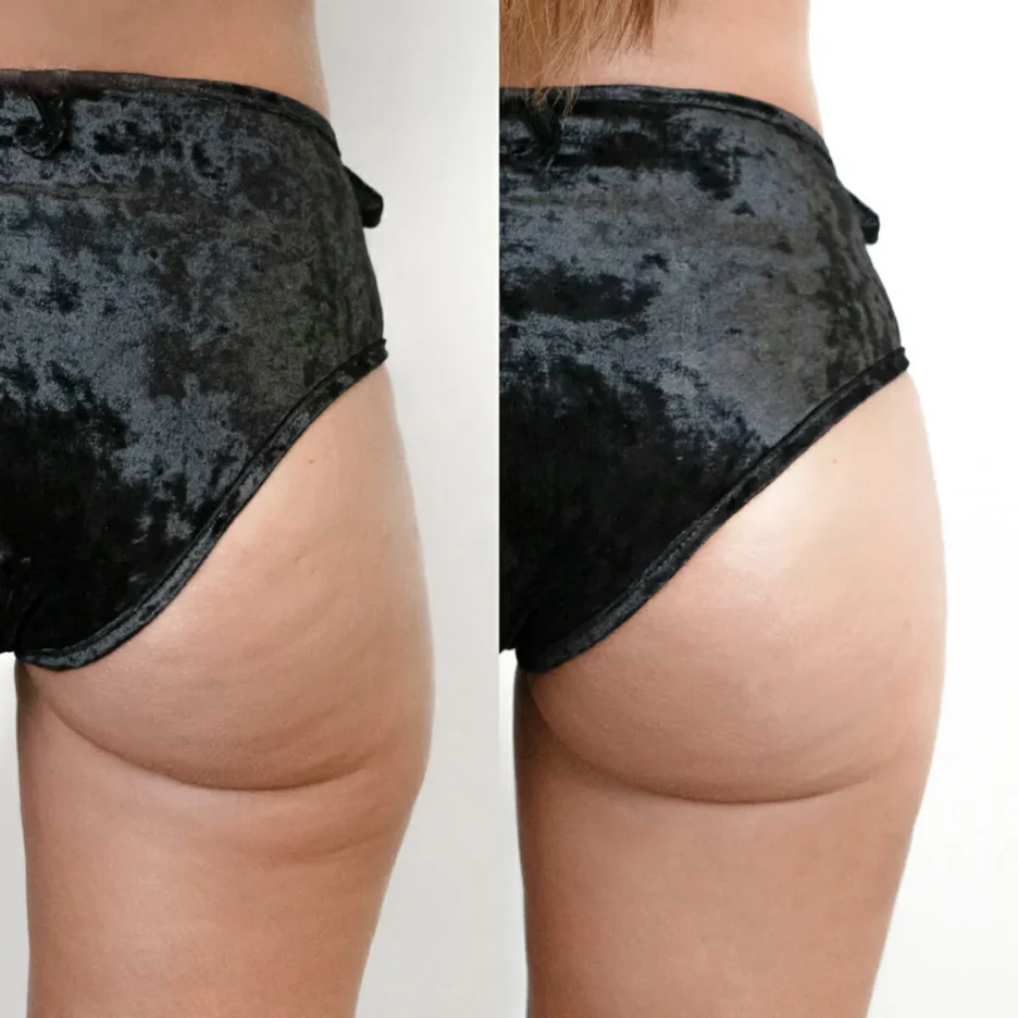 Clínica Estética Dra. Noelia Gon - Relleno de Gluteo - gluteos2.jpg